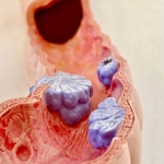 March is Colon Cancer Awareness Month