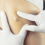 Skin Lumps and Bumps – Important Facts to Know
